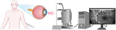 Changes in foveal avascular zone area and retinal vein diameter in patients with retinal vein occlusion detected by fundus fluorescein angiography